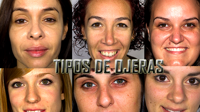tipos de ojeras
