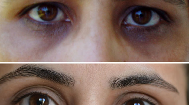 ojeras