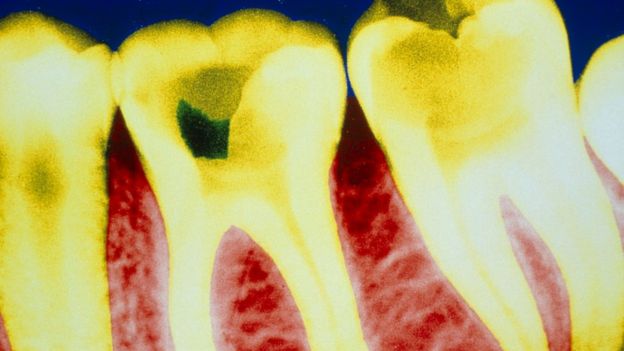 Descubren un nuevo uso potencial de la aspirina: reparar las caries