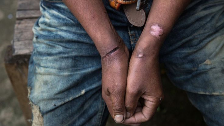 LAUREN DECICCA/GETTY IMAGES Un trabajador indocumentado en Tailandia muestra las heridas que le causaron las esposas cuando fue arrestado. Las autoridades de ese país han implementado nuevas regulaciones para combatir la trata de personas.