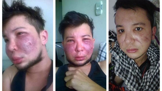 "Tenía mi cara destruida, podrida, me salía pus": los peligros de caer en malas manos al hacerse cirugías estéticas