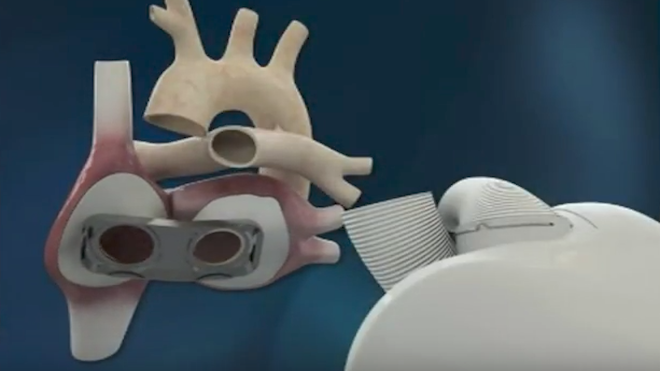Médicos anuncian primer implante de corazón artificial