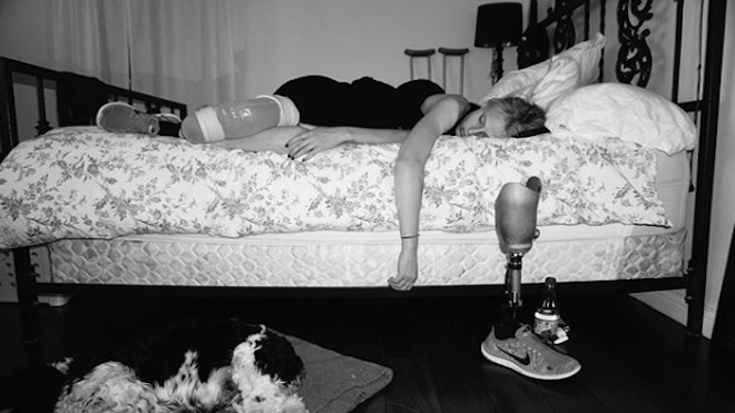 Amputan la segunda pierna de la modelo que se infectó con un tampón