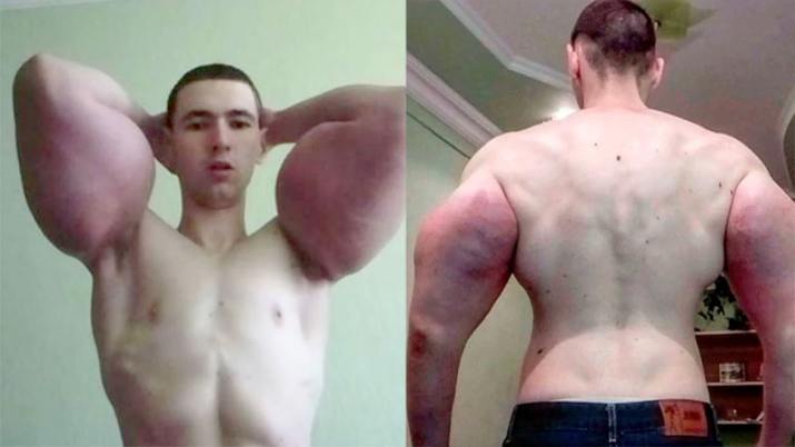 El Popeye Ruso se somete a operación para salvar su vida luego de inyectarse aceite en los brazos