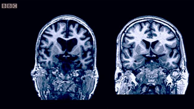 Dos cerebros de personas de la misma edad: el cerebro de la de la izquierda se ha encogido más. (Foto Guatevisión: BBC Mundo)