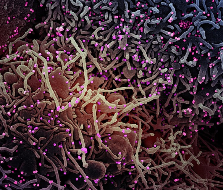 Coronavirus (en rosa) en el interior de una célula humana.