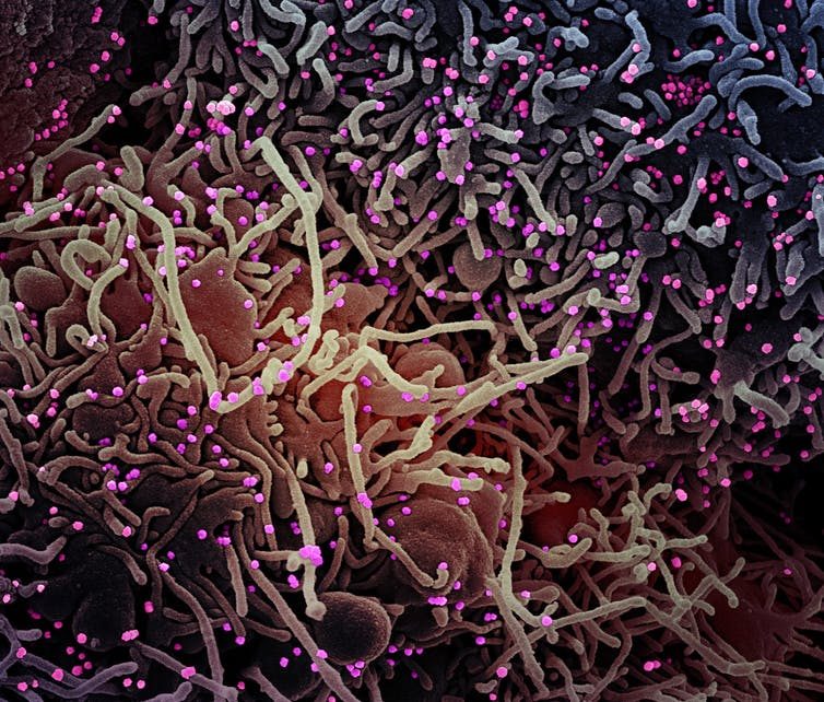 Coronavirus (en rosa) en el interior de una célula humana.