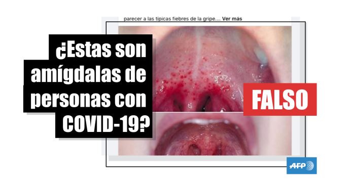 amígdalas infectadas