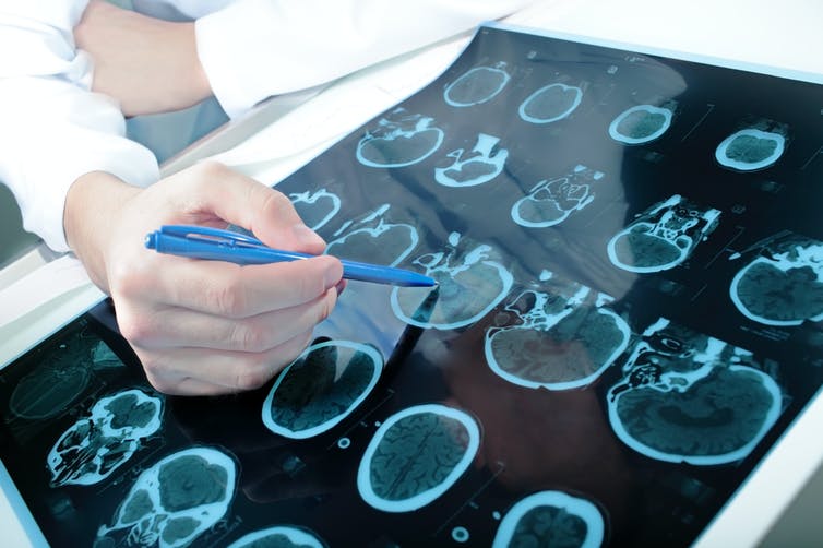 ¿Por qué los diabéticos tienen una mayor tendencia a desarrollar la enfermedad de Parkinson?