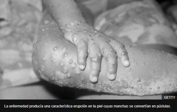 Coronavirus: la viruela, la única enfermedad humana que ha sido erradicada y qué lecciones dejó para enfrentar la pandemia de covid-19