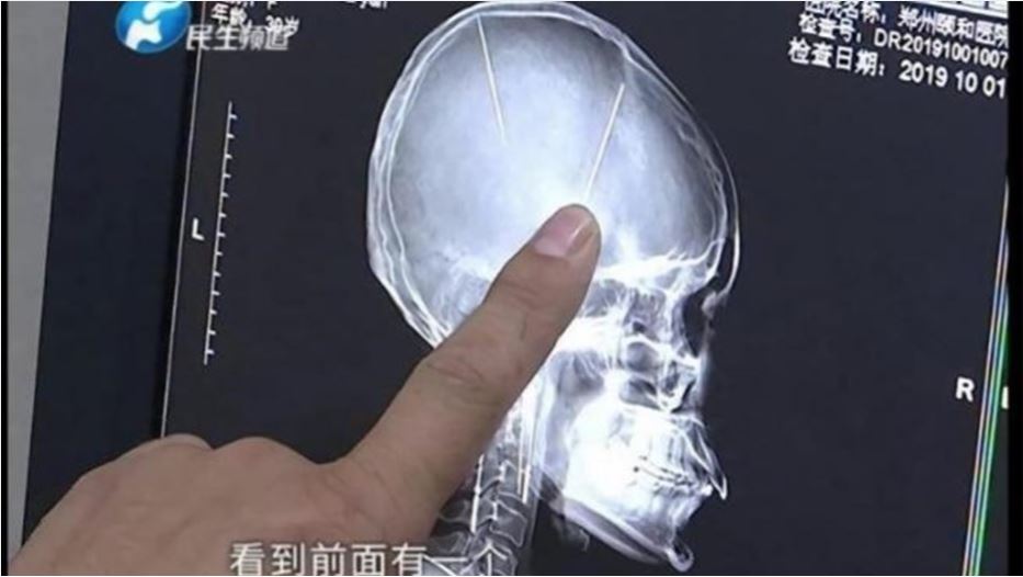 Mujer se hace una tomografía a causa de un accidente de tránsito y descubre que tiene dos agujas en el cerebro