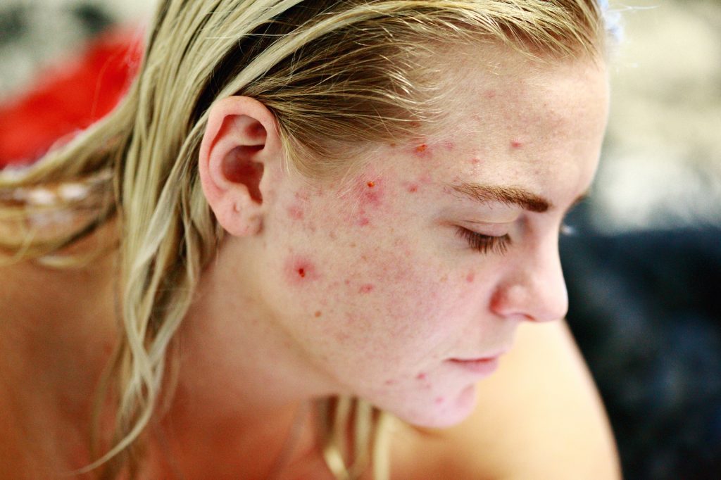 Mascarillas el acné (consejos para eliminarlo)