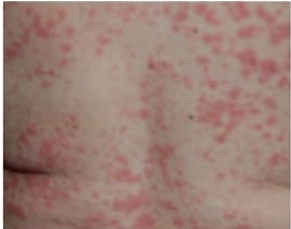 urticaria