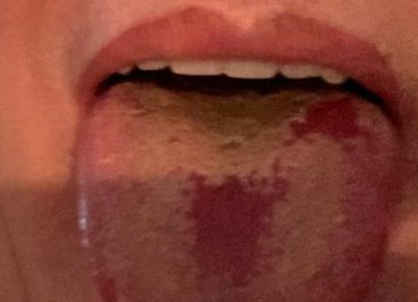 ‘Lengua Covid’, el nuevo síntoma del coronavirus del que alerta un epidemiólogo británico