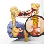 Qué es la enfermedad diverticular por la que fue operado el papa Francisco
