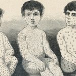 La misteriosa “amnesia inmunológica” causada por el sarampión (y cómo puede afectar la protección contra covid)