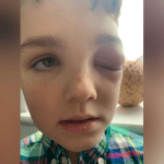 Coronavirus en el mundo: Niño casi pierde un ojo tras contagiarse de covid-19