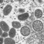 Viruela del mono: cuál es el perfil de los infectados y cómo puede cambiar a medida que avanza la enfermedad