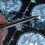 Día Mundial del Alzhéimer: lo que hemos aprendido sobre la enfermedad en los últimos 4 años
