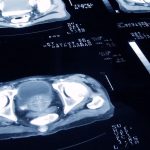 El estudio que revela que el cáncer de próstata se puede curar con menos sesiones de radioterapia (y el “enorme cambio” que significa en el tratamiento de la enfermedad)