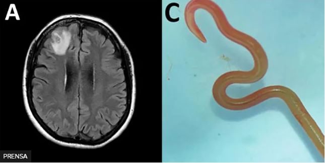 Un gusano vivo en el cerebro de una mujer y otras 4 noticias de salud que causaron impacto en 2023