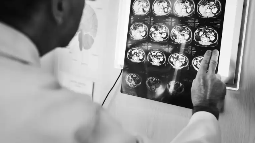 Enfermedad neurológica en Guatemala