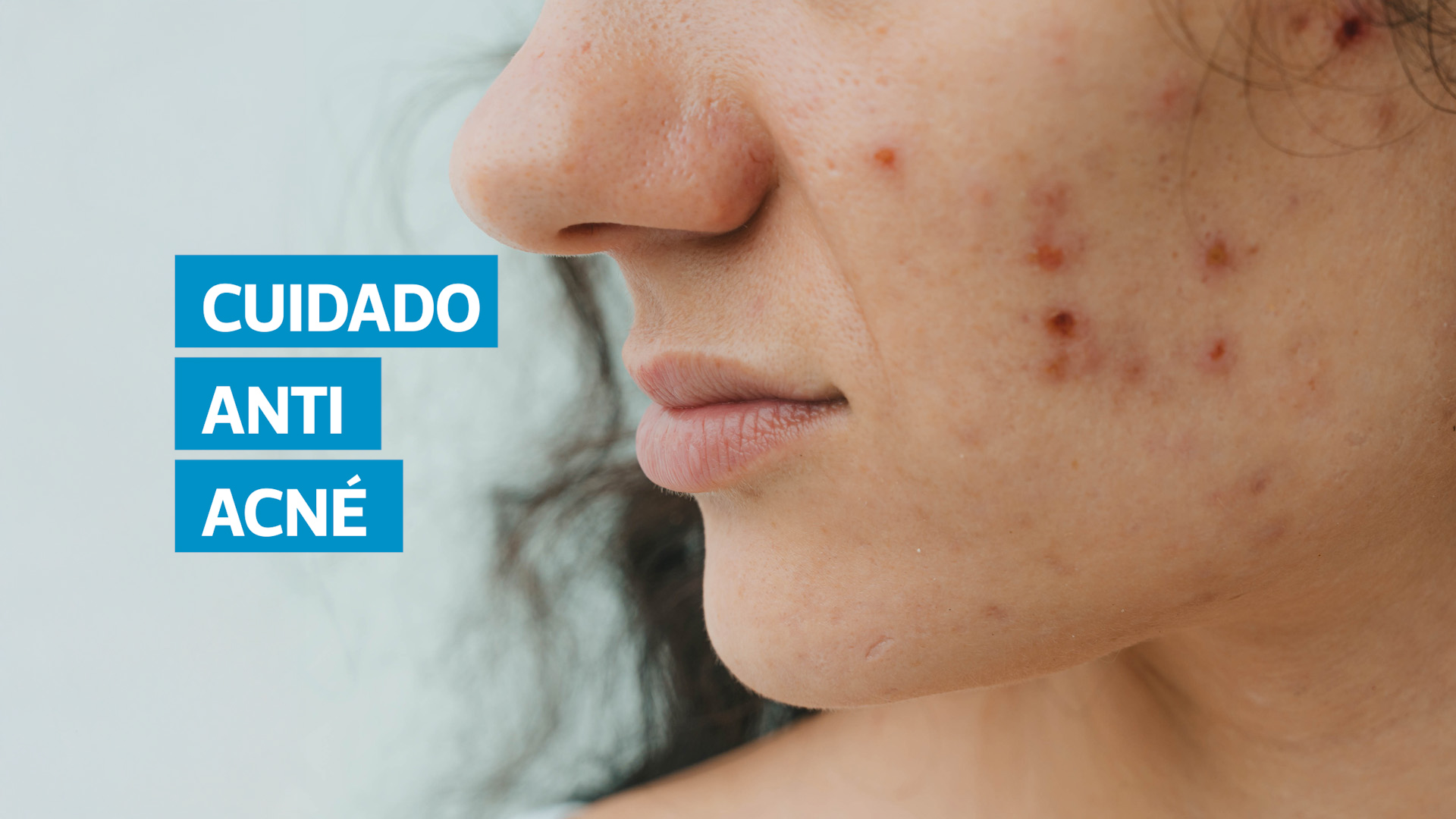 VIDEO | Acné: causas, síntomas y tratamientos efectivos según especialistas