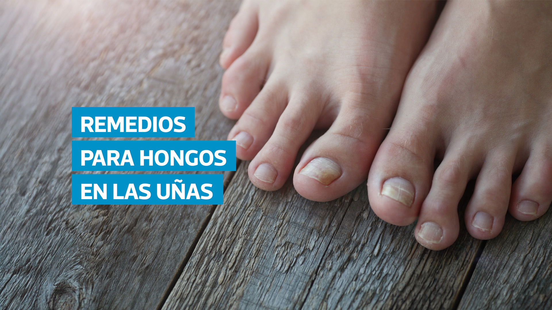 VIDEO | Qué remedios ayudan a tratar los hongos en las uñas