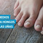VIDEO | Qué remedios ayudan a tratar los hongos en las uñas